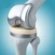 Rediscover Mobility Knee Replacement Surgery in Faridabad