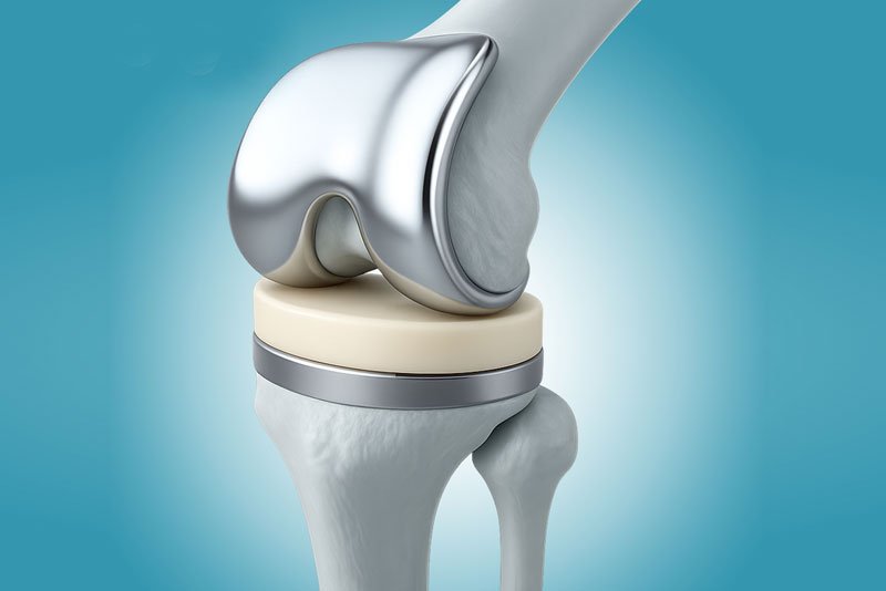 Rediscover Mobility Knee Replacement Surgery in Faridabad
