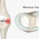 Meniscus tear surgery in Faridabad arthroscopic meniscus repair Dr. Sunil Choudhary UK-trained orthopedic knee specialist