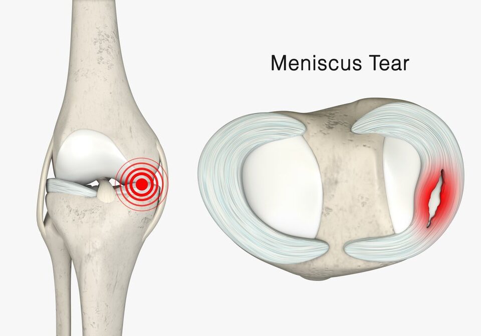 Meniscus tear surgery in Faridabad arthroscopic meniscus repair Dr. Sunil Choudhary UK-trained orthopedic knee specialist