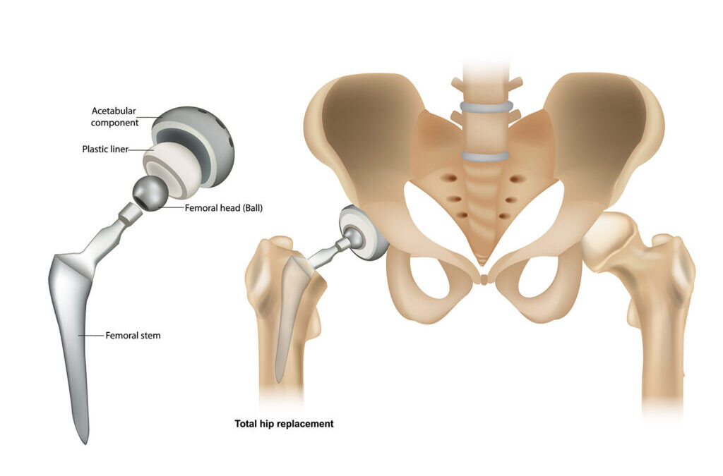 Partial hip replacement in Faridabad hemiarthroplasty unicondylar hip Dr. Sunil Choudhary UK-trained orthopedic surgeon