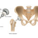 Partial hip replacement in Faridabad hemiarthroplasty unicondylar hip Dr. Sunil Choudhary UK-trained orthopedic surgeon