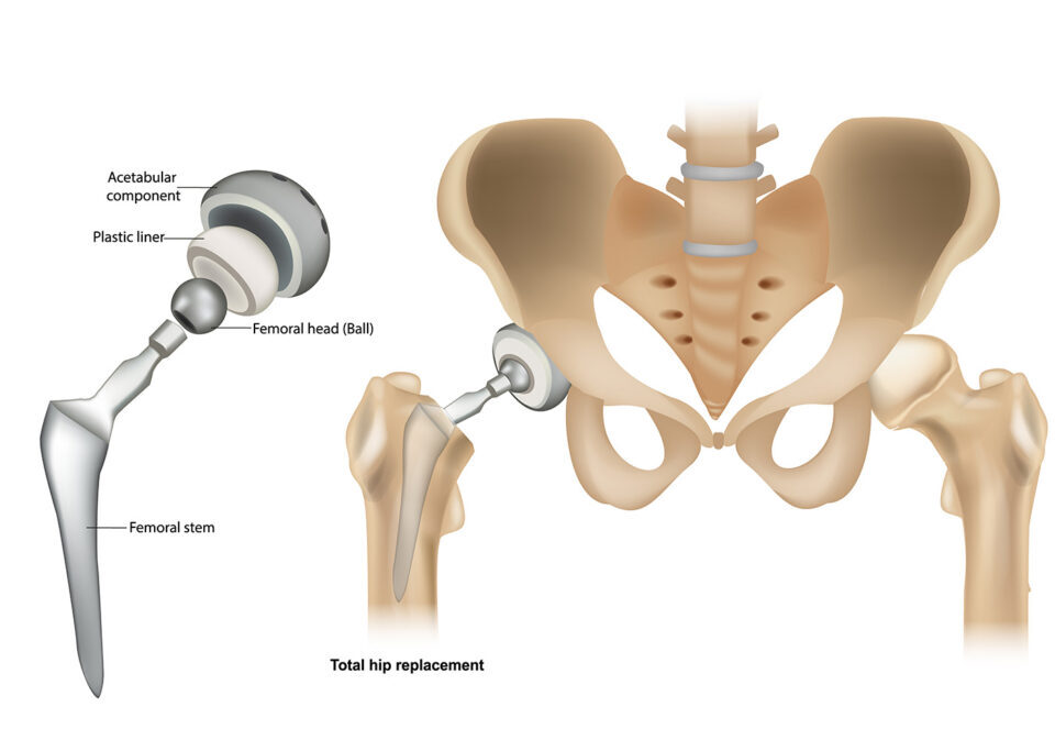 Partial hip replacement in Faridabad hemiarthroplasty unicondylar hip Dr. Sunil Choudhary UK-trained orthopedic surgeon
