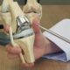 Revision total knee replacement surgery in Faridabad failed implant Dr. Sunil Choudhary orthopedic surgeon