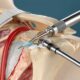 Bankart repair in Faridabad shoulder instability recurrent dislocation arthroscopic labrum repair Dr. Sunil Choudhary UK trained