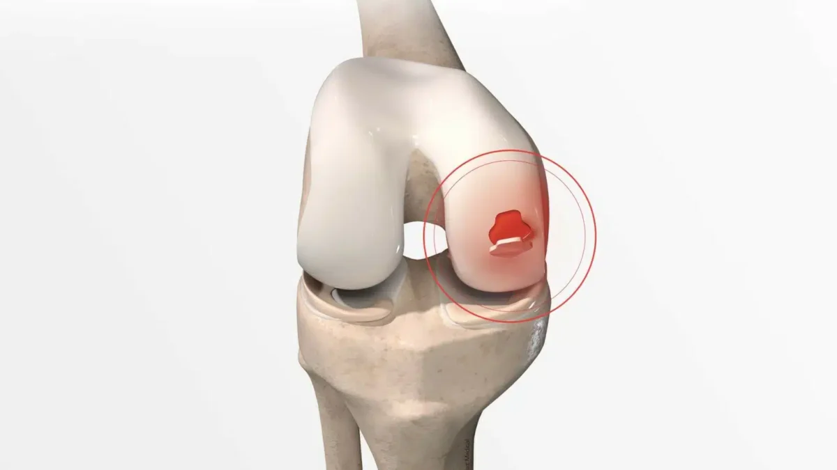 Cartilage surgery in Faridabad microfracture OATS chondral repair Dr. Sunil Choudhary orthopedic specialist