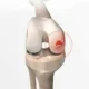Cartilage surgery in Faridabad microfracture OATS chondral repair Dr. Sunil Choudhary orthopedic specialist