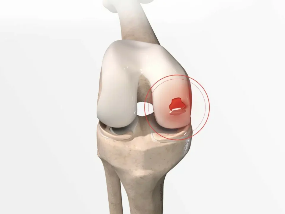 Cartilage surgery in Faridabad microfracture OATS chondral repair Dr. Sunil Choudhary orthopedic specialist