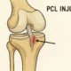 PCL Injury Treatment in Faridabad The Most Under-Diagnosed Knee Ligament Injury