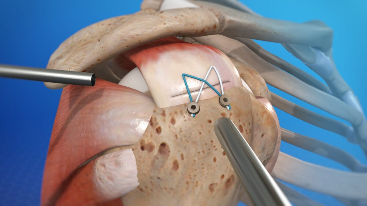 Rotator cuff repair in Faridabad arthroscopic shoulder surgery Dr. Sunil Choudhary UK-trained orthopedic specialist