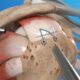 Rotator cuff repair in Faridabad arthroscopic shoulder surgery Dr. Sunil Choudhary UK-trained orthopedic specialist