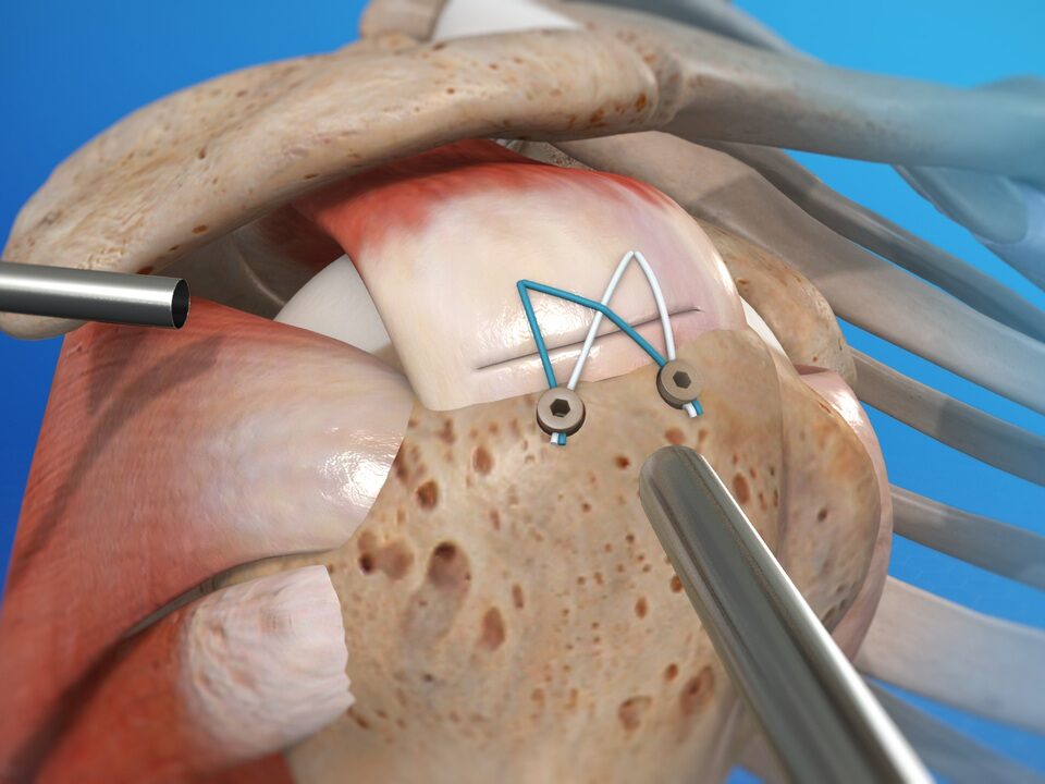 Rotator cuff repair in Faridabad arthroscopic shoulder surgery Dr. Sunil Choudhary UK-trained orthopedic specialist